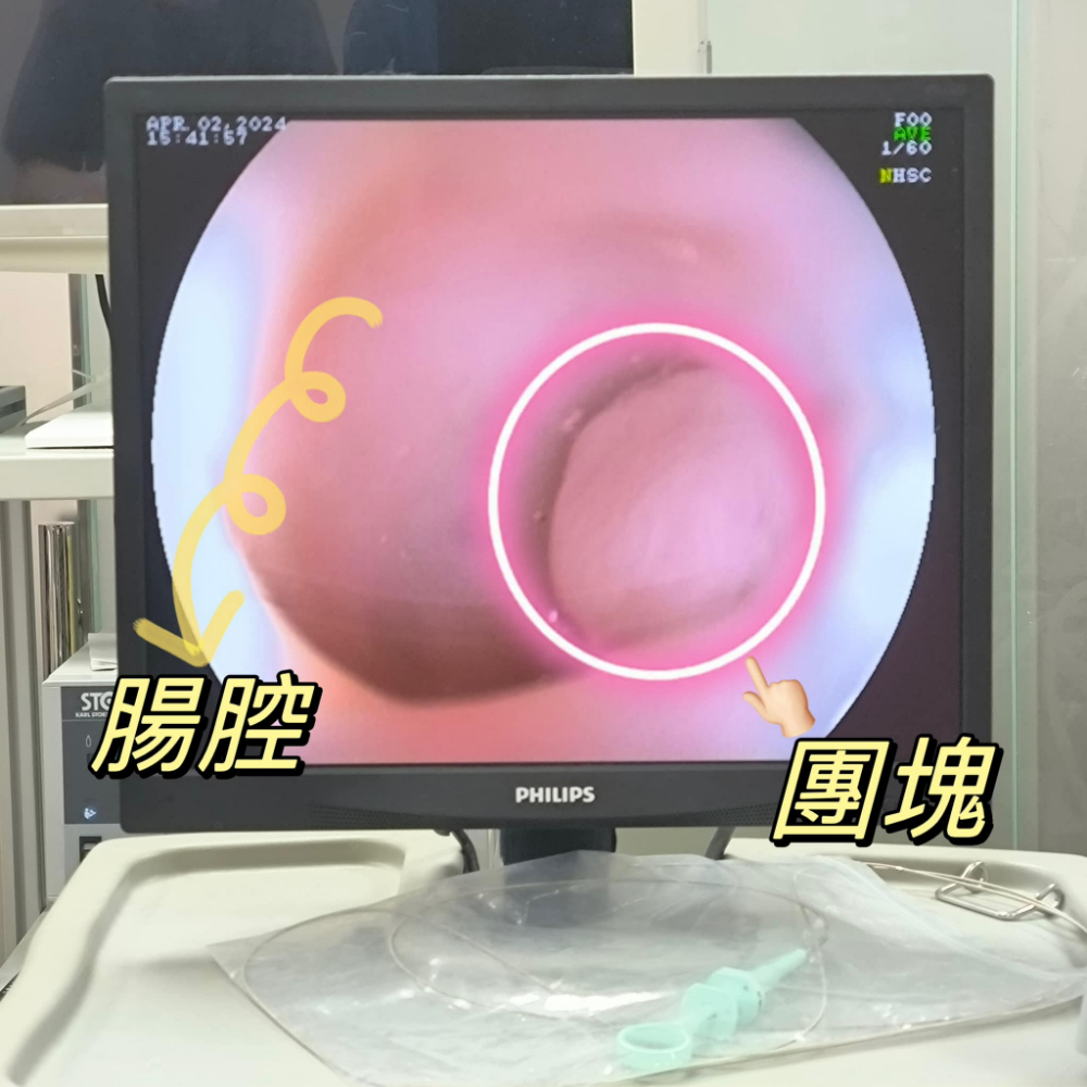 《胃腺瘤》