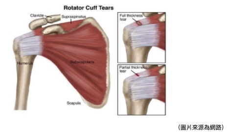 旋轉肌袖破裂