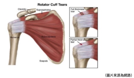 Physical Therapy Guide to Rotator Cuff Tear - ChoosePT.com