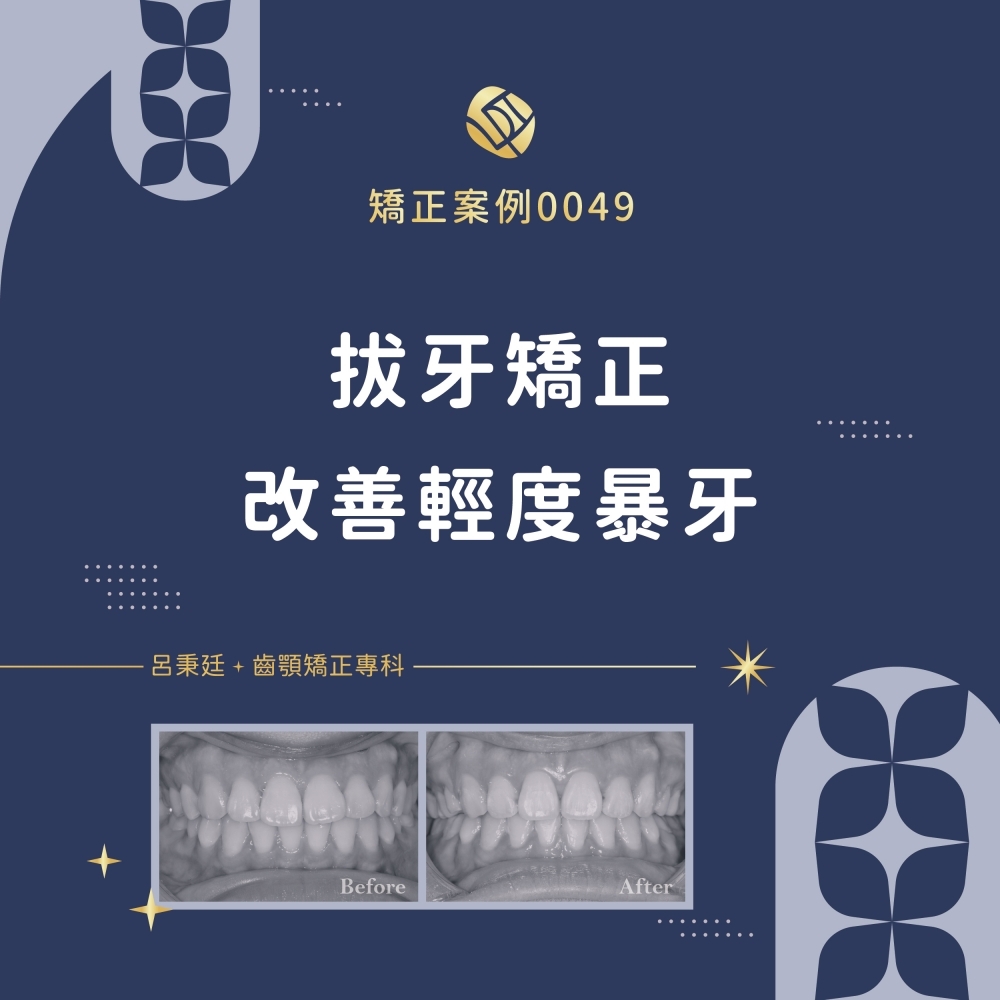 暴牙案例-矯正案例0