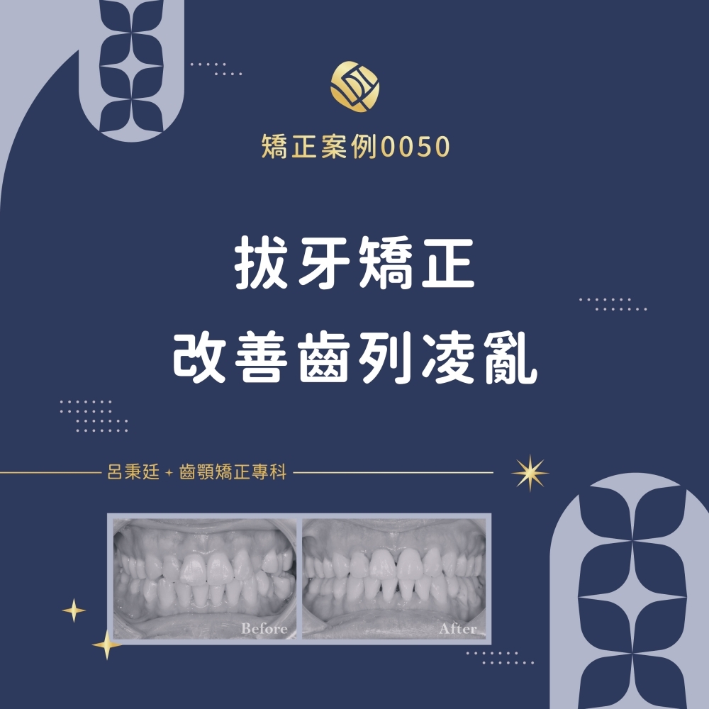 擁擠案例-矯正案例0