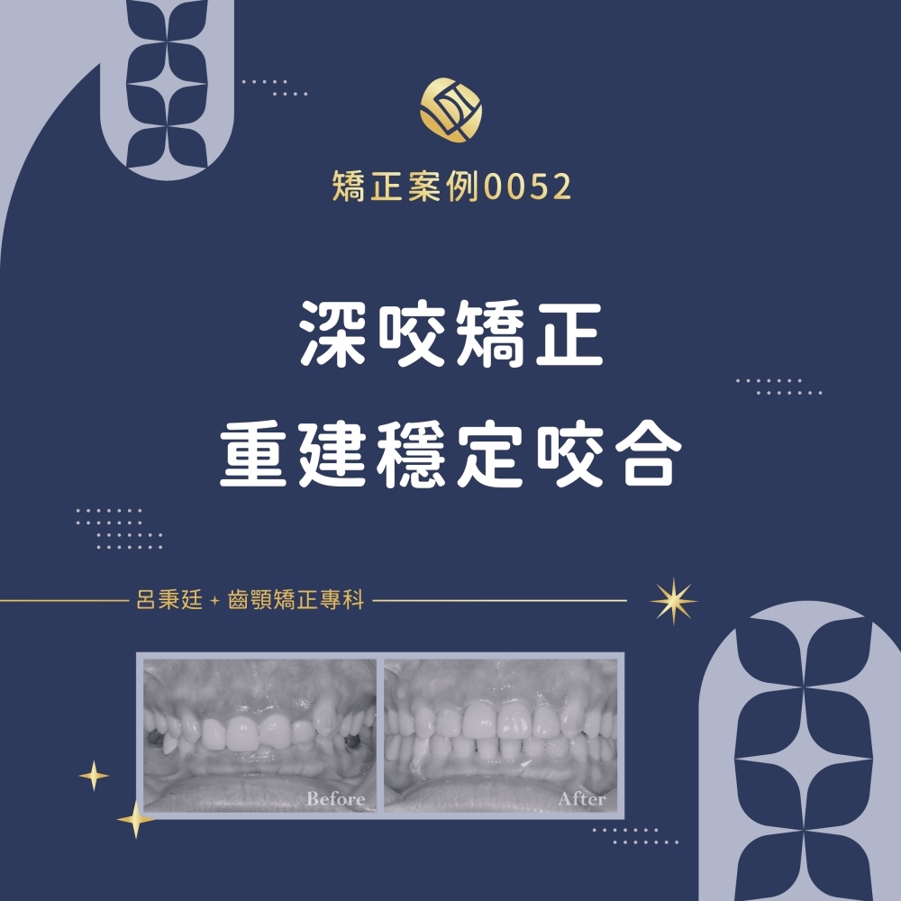 深咬案例-矯正案例0