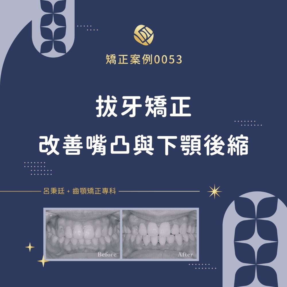 暴牙案例-矯正案例0