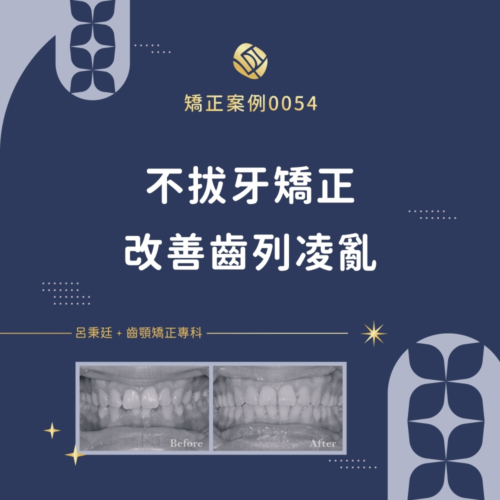 擁擠案例-矯正案例0