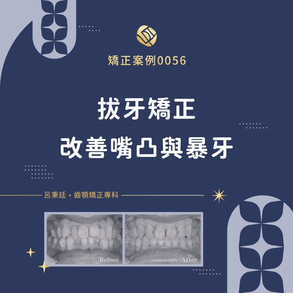 暴牙案例-矯正案例0
