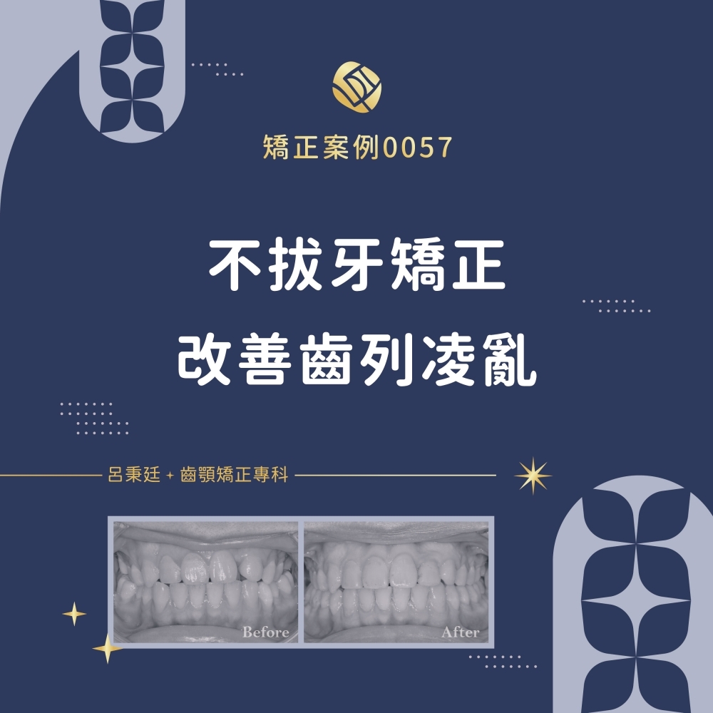 擁擠案例-矯正案例0