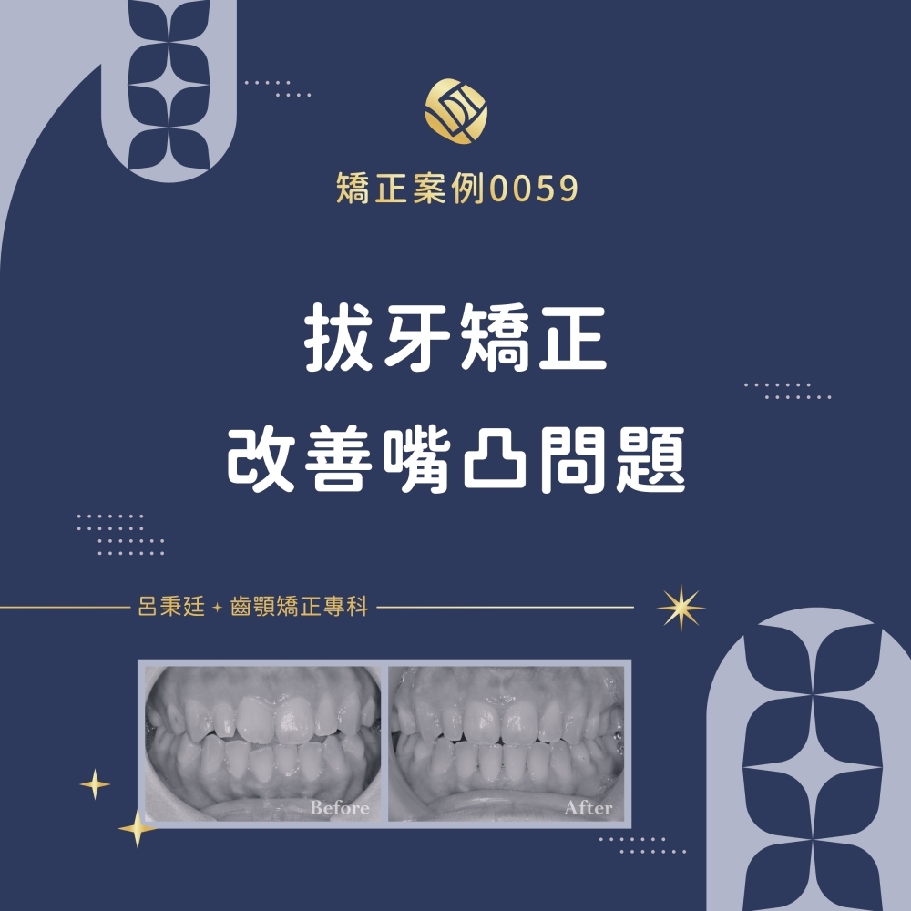 暴牙案例-矯正案例0